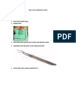 How To Do Composite Filling