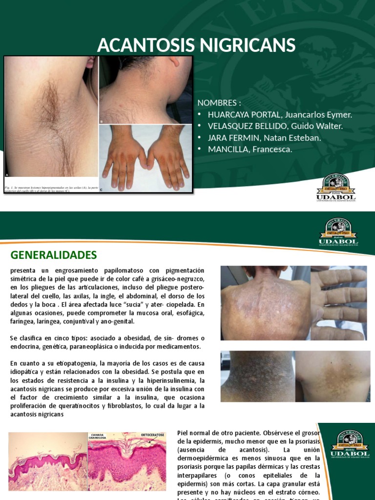ACANTOSIS | PDF | Cáncer | Diabetes
