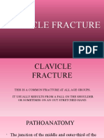 Clavicle Fracture