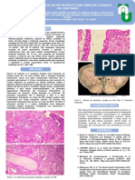 Teratoma testicular raro em paciente com hidrocele gigante