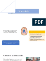 Hidrocefalia: Causas, Síntomas y Tratamiento