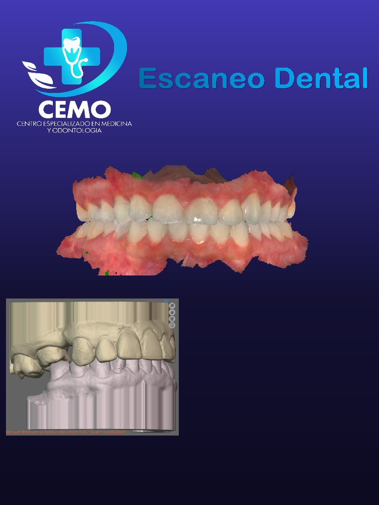 Scaner Intraoral | PDF