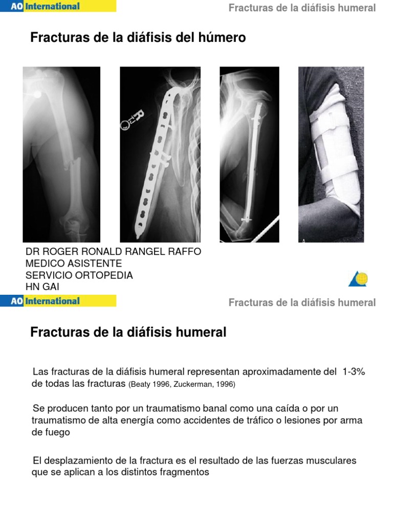 Tratamiento de Fracturas Diafisarias de Húmero | PDF | Sistema ...