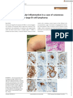 The Journal of Dermatology - 2022 - Sakamoto - T Cell Rich Perivascular Inflammation in A Case of Cutaneous Variant