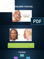 Paralisis Facial