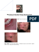 Alpha Blood Root Paste Results