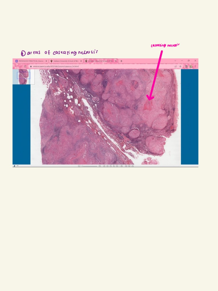 Of Caseating Netwosis: Areas | PDF