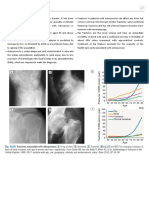 OSTEOPOROSIS