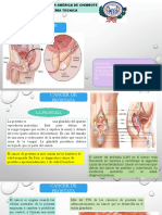 Cancer de Prostata