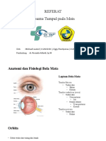 Referat - Trauma Tumpul Mata