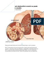 4 Boala Pulmonară Obstructivă Cronică Se Poate Trata Cu Ulei de Canabis