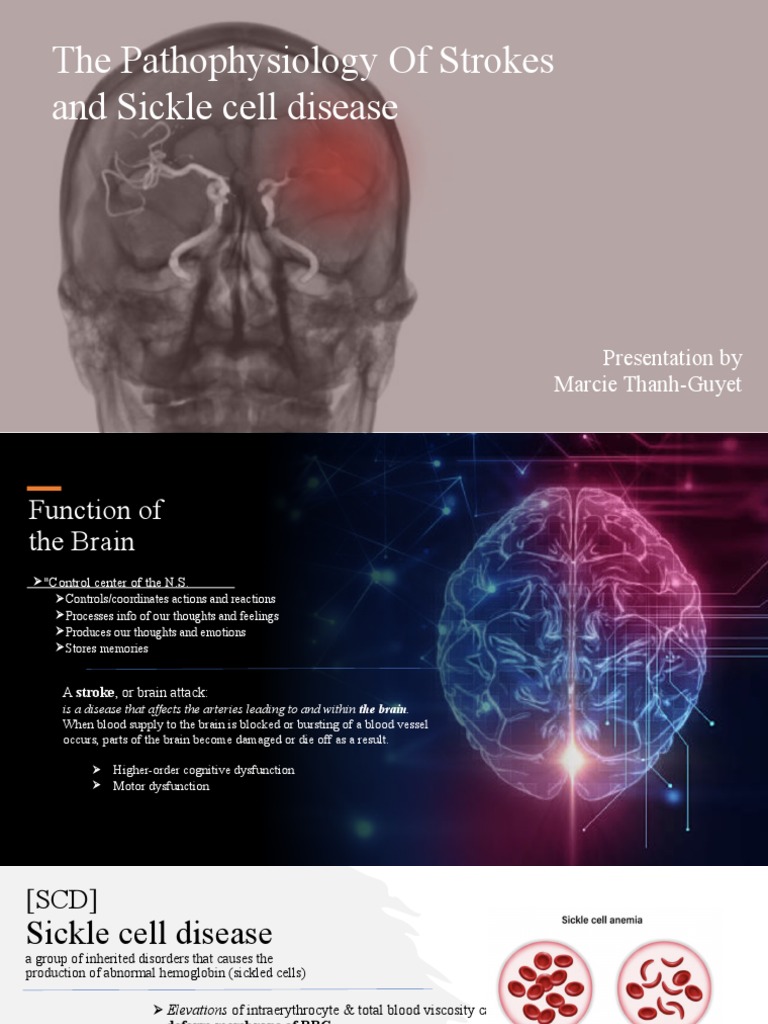 Stroke Pathophysiology in Sickle Cell Disease | PDF | Stroke | Ischemia