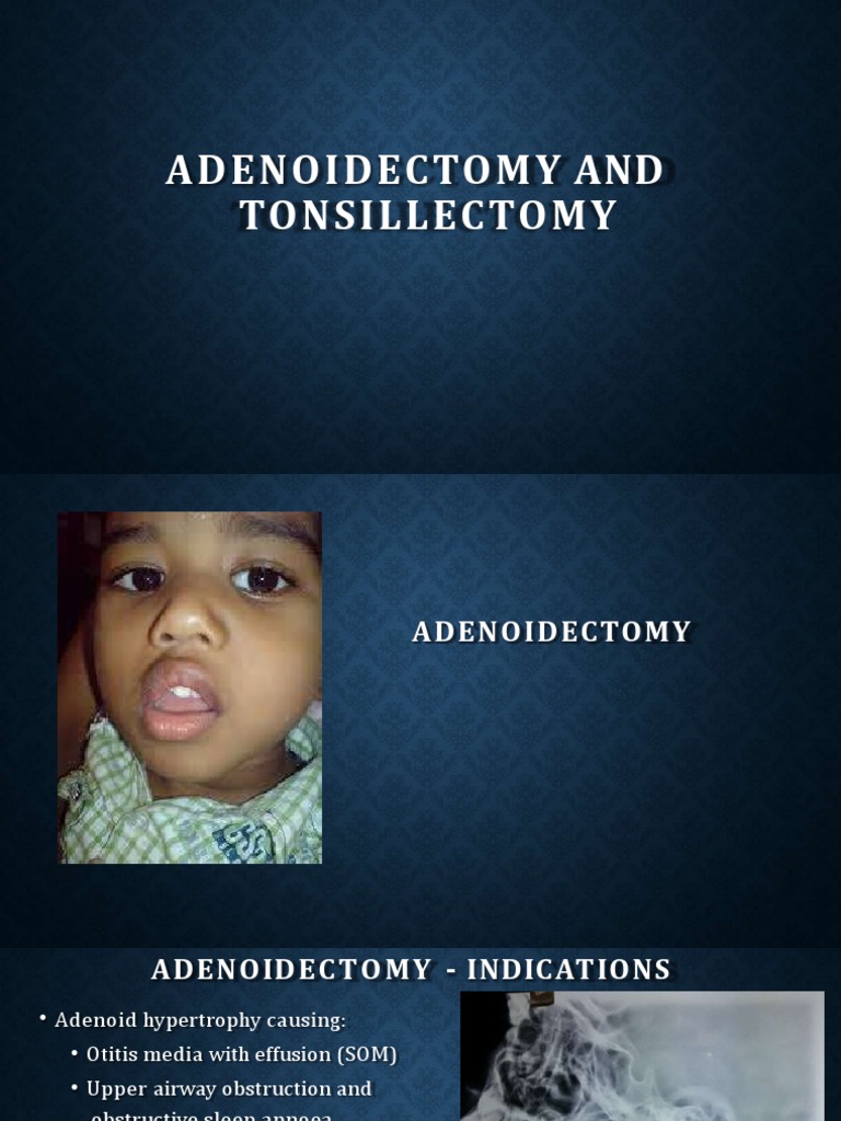 Adenoidectomy and Tonsillectomy 2 PDF Bleeding Vertebral Column