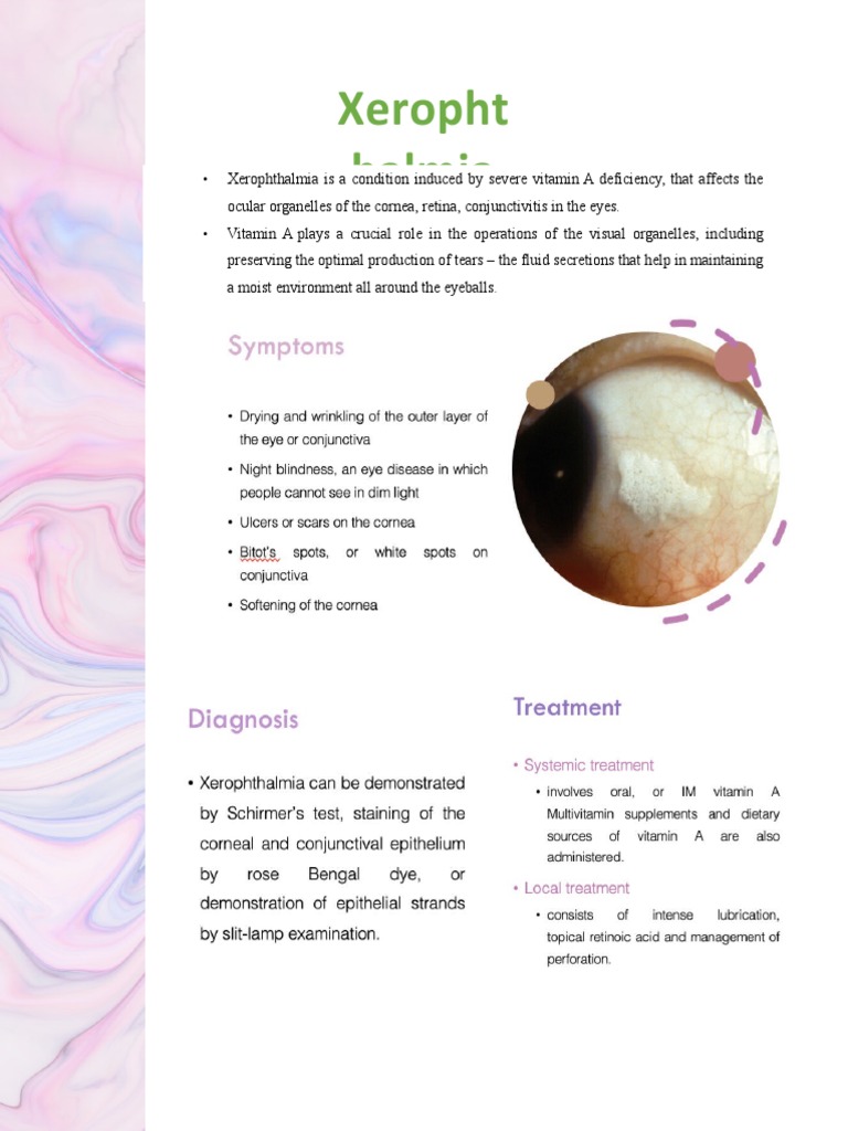 Xerophthalmia PDF