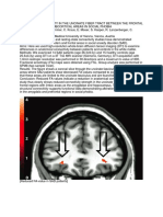 P01-182 - Reduced Connectivity in The Uncinate Fiber Tract Between The Frontal Cortex and Limbic Subcortical Areas in Social Phobia (European Psychiatry, Vol. 26, Issue Supp-S1) (2011)