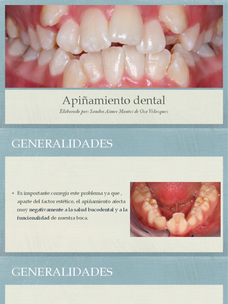 Apiñamiento Dental PDF | PDF | Odontología | Especialidades Medicas