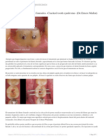 Tratamiento de Los Dientes Fisurados Cracked Tooth Syndrome (DR - Ernest Mallat)