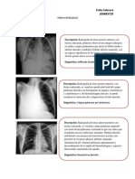 Torax Patologico-Tarea