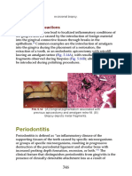 Periodontitis: Foreign-Body Reactions