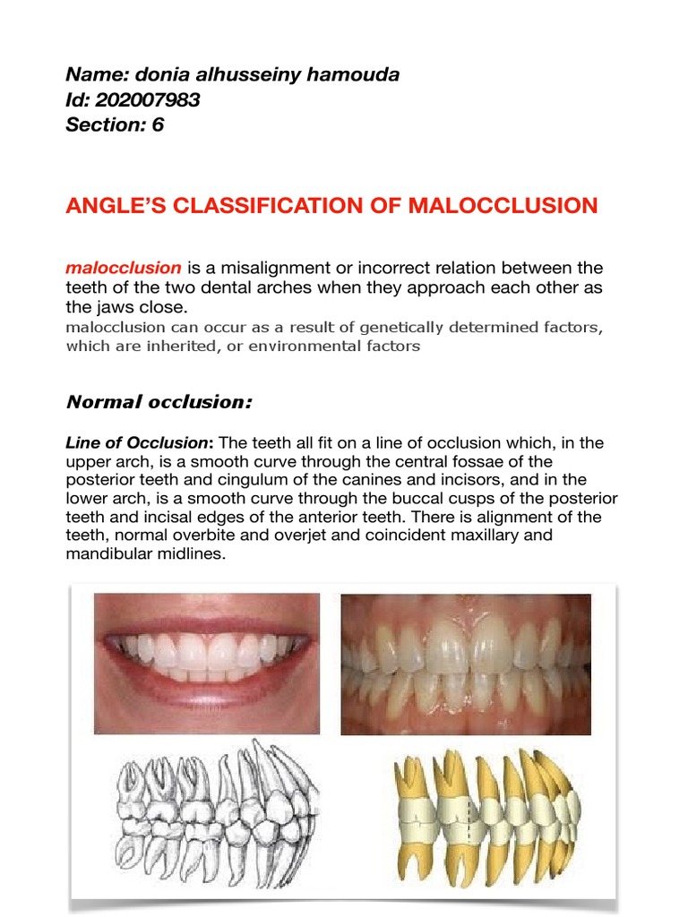 Donia alhussieny hamouda classifications of malocclusion pdf