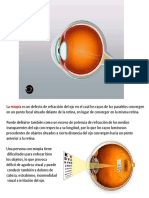 La miopía: defecto de refracción que causa problemas de visión