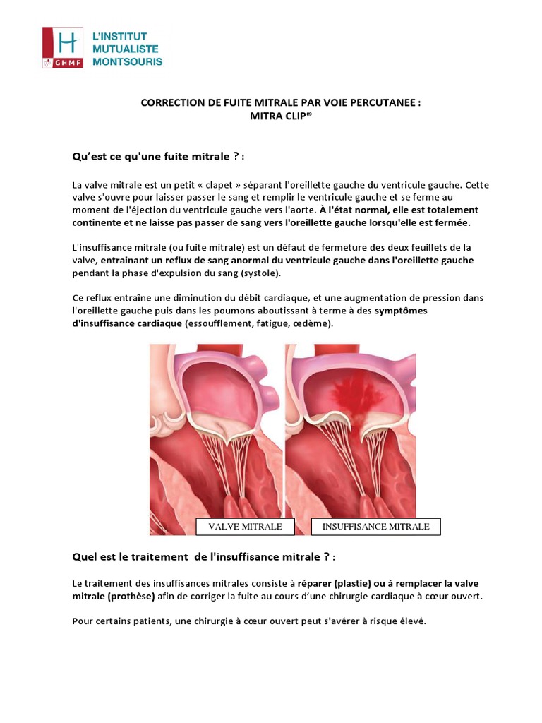 Fiche Info Site Mitra Clip | PDF | Atrium (anatomie) | Cœur