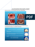 Protesis Removible