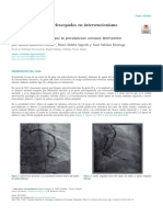 Técnica de Catéteres Telescopados en Intervencionismo Coronario Percutáneo