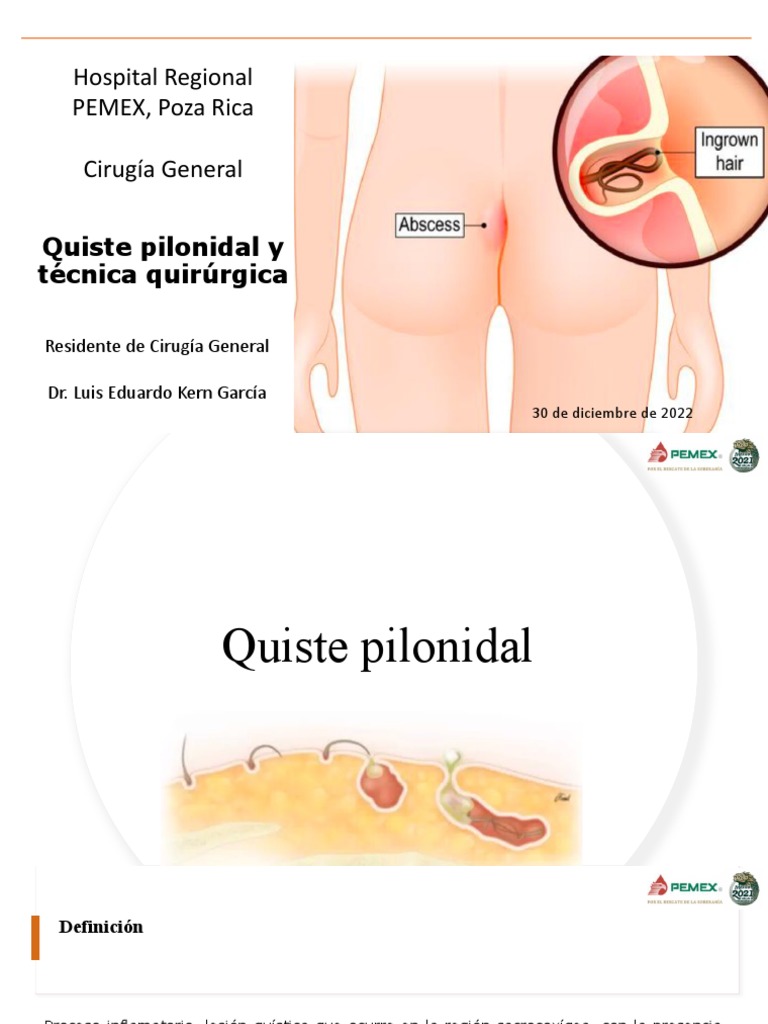 Quiste Pilonidal y Técnica Karydakis | PDF | Diagnostico medico ...