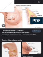 Cancer de Mama