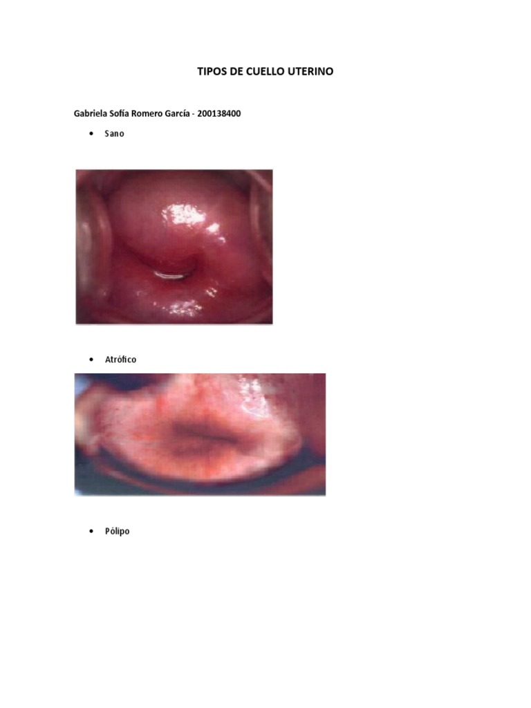 Los diferentes tipos de cuello uterino y sus características | PDF
