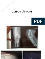 Casos Clínicos Fracturas