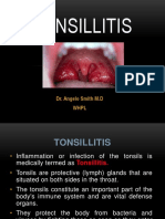 Tonsillitis