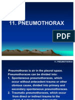 Pneumotoraks