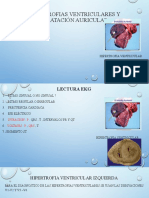 Hipertrofia Ventricular - Dilatacion Auricular