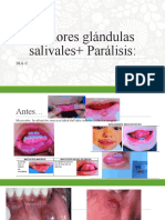 Tumores glándulas salivales y parálisis facial
