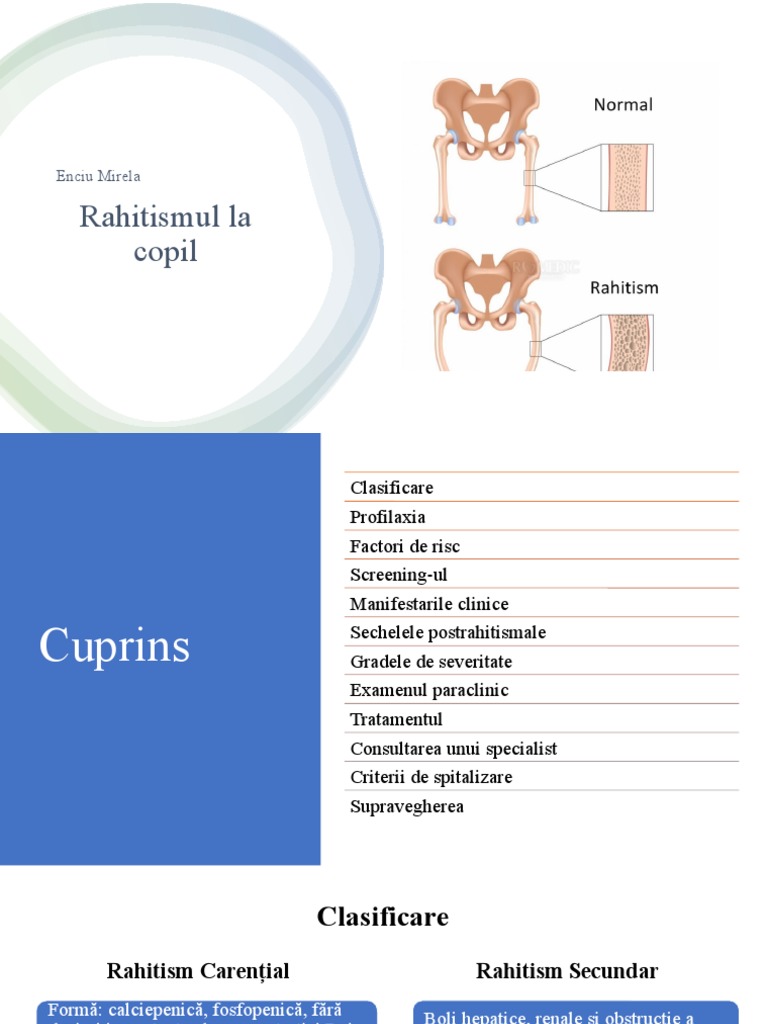 Rahitismul La Copil Enciu Mirela | PDF