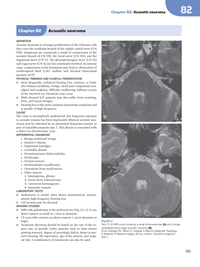 Acoustic Neuroma PDF Radiation Therapy Vertigo