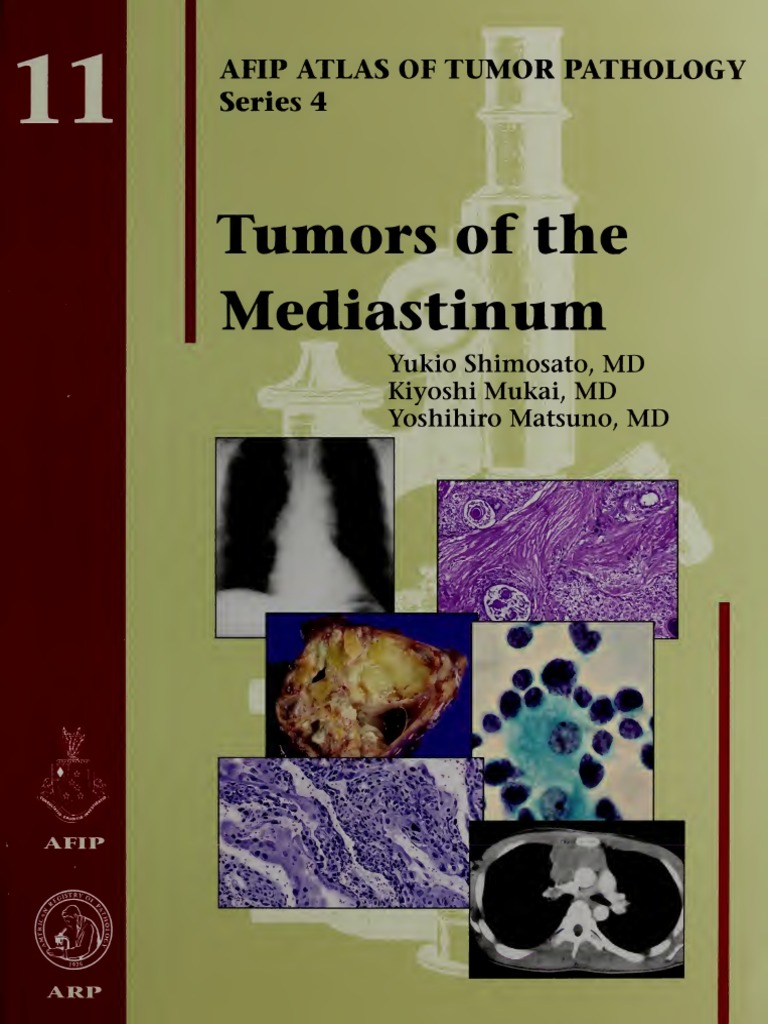 Tumors of The Mediastinum PDF Thymus Carcinoma