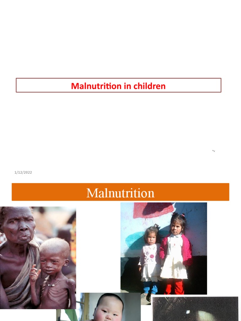 Understanding Child Malnutrition | PDF | Malnutrition | Vitamin D
