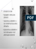 Tratamiento y diagnóstico de dilatación de la aorta ascendente