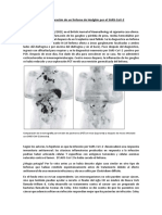 El Extraño Caso de La Curación de Un Linfoma de Hodgkin Por El SARS-CoV-2