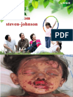 Sindrom Steven-Johnson