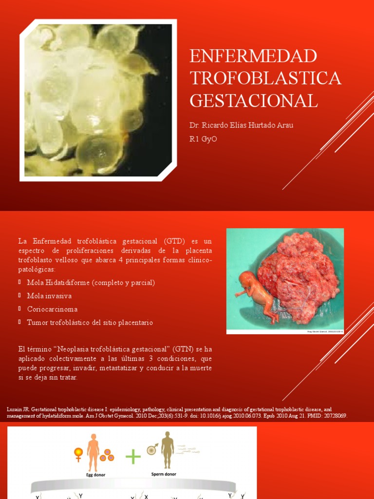 Enfermedad Trofoblastica Gestacional | PDF | Gonadotropina coriónica