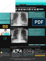 Chest X-Ray - Pulmonary Disease - Bronchiectasis and Cystic Fibrosis