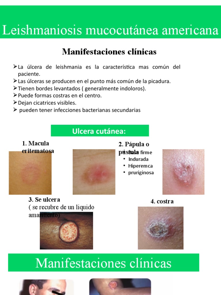 Leishmaniasis 2 | PDF