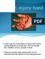 Crush Injury Hand