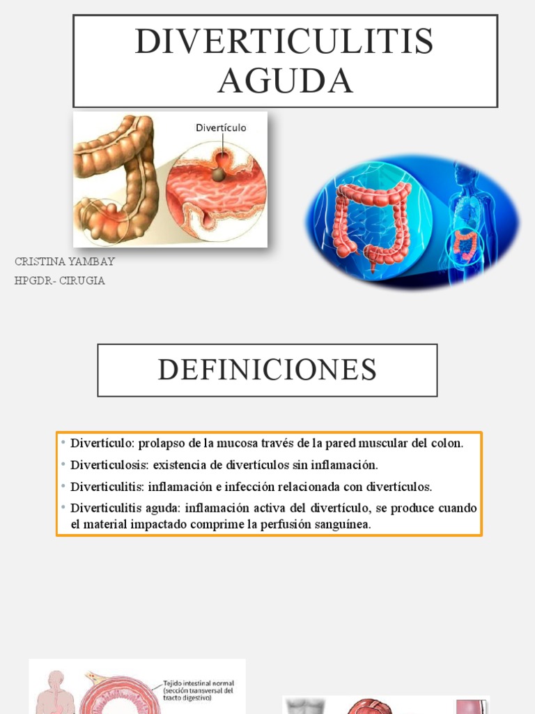 Diverticulitis Aguda | PDF | Cáncer colonrectal | Enfermedades y ...