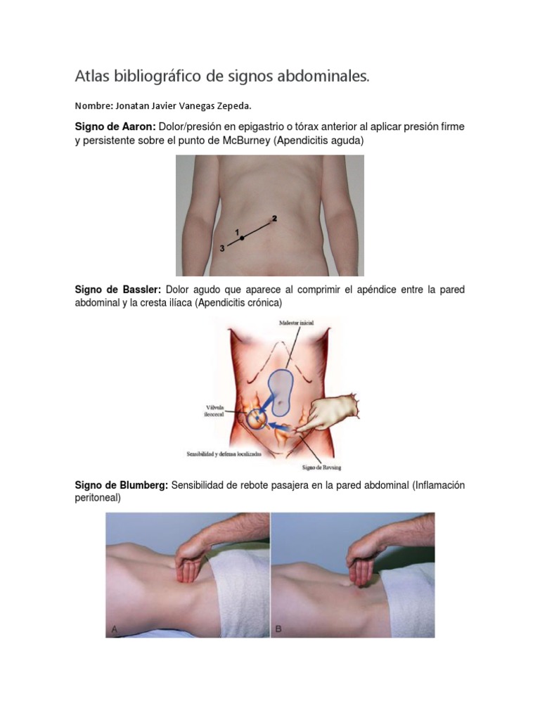 Signos Abdominales en Apendicitis | PDF