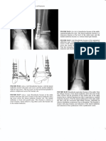 Treatment and Rehabilitation of Fractures (Stanley Hoppenfeld)